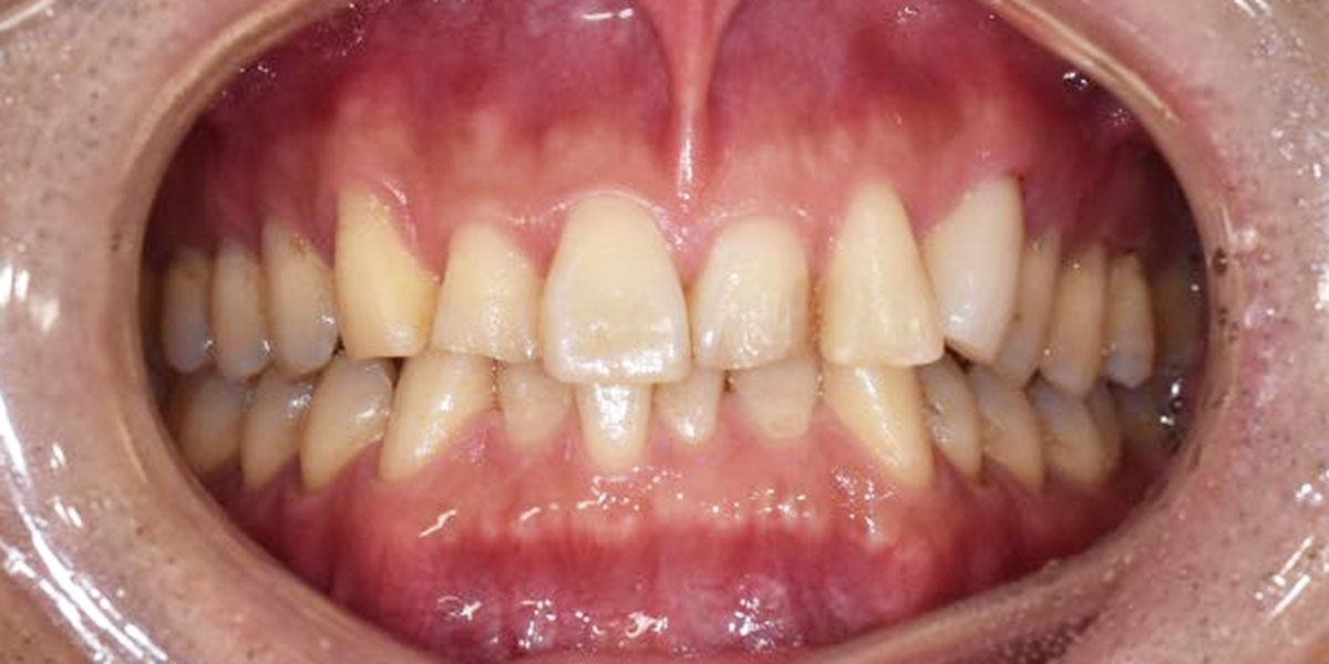 治療前の下の歯