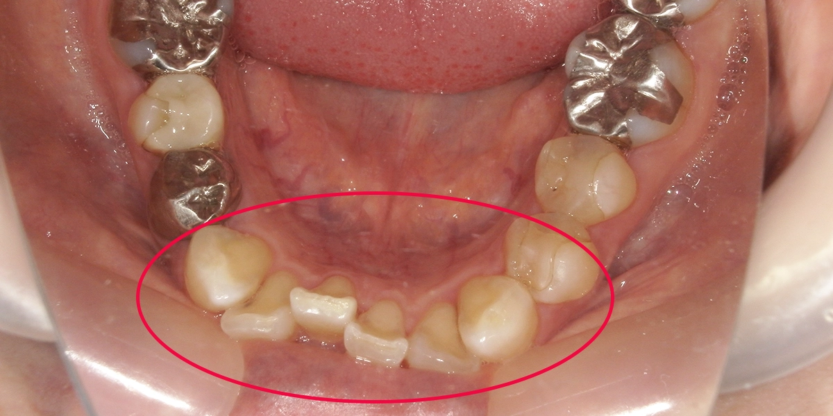 治療前の下の歯