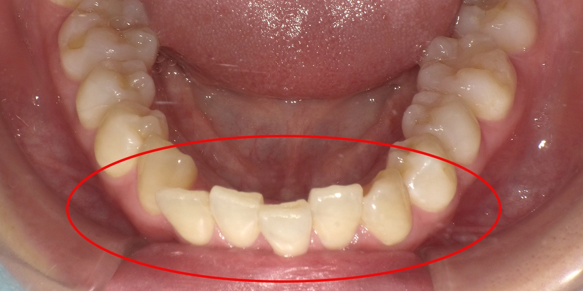 治療前の下の歯