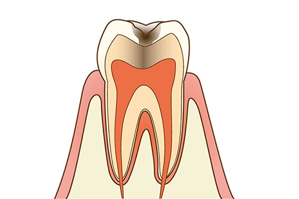 C2：神経に近い虫歯