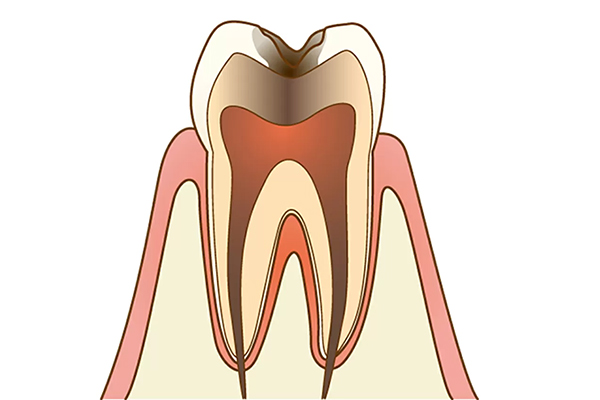 C3：神経に到達した虫歯