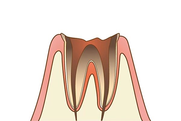 C4：末期の虫歯