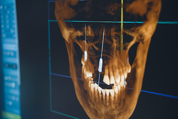骨造成を伴う前歯の難症例