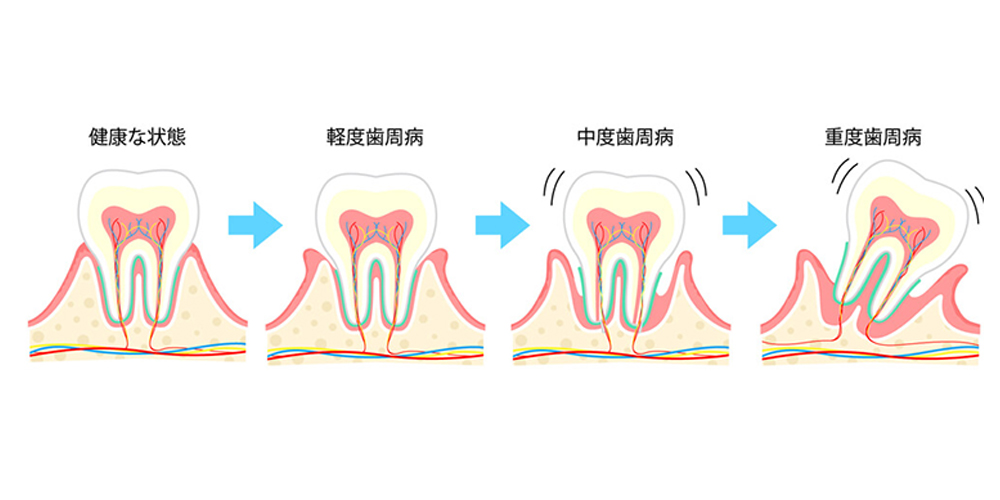 歯周病の進行別症状